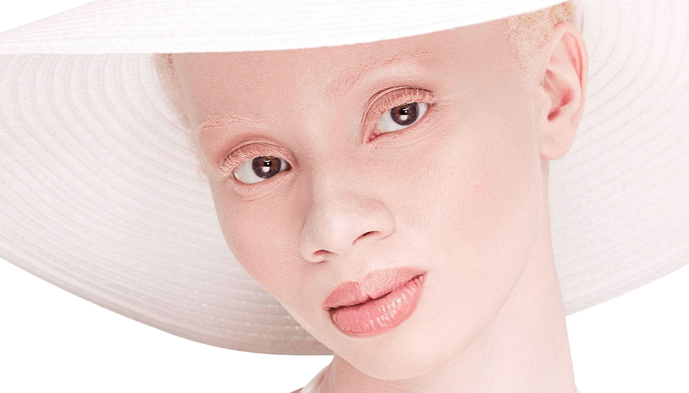 Miss Albinos, de Cynthia Pinet, Prix Movies That Matter au Sunny Side of the doc